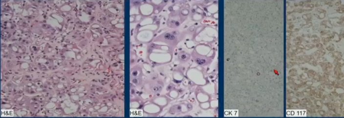 tumor views.jpg