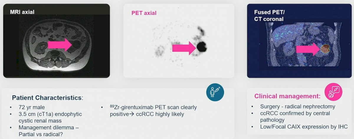ASCO GU 23  ZIRCON study.jpg