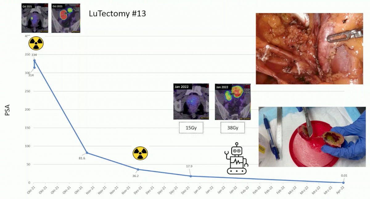 lutectomy 13.jpg