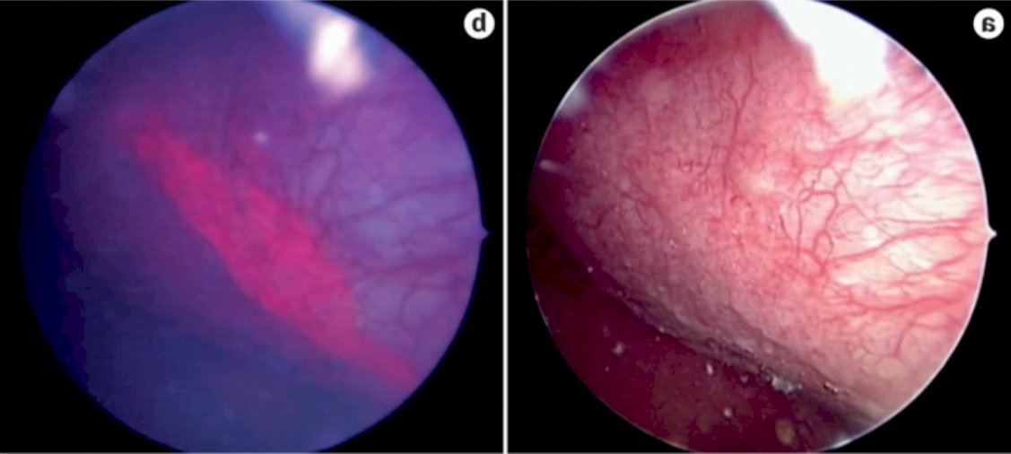 blue light cystoscopy EAU.jpg