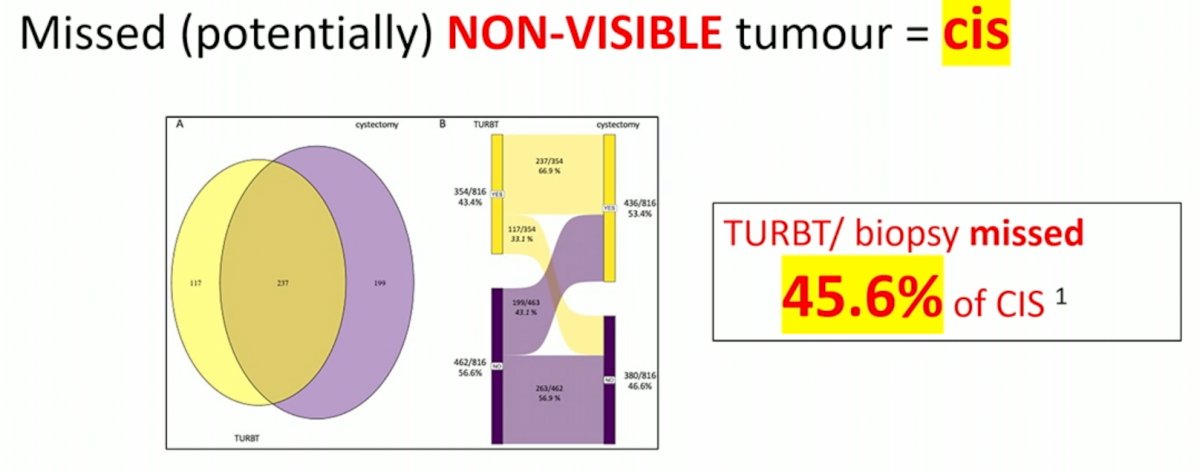 Turbt biopsy.jpg