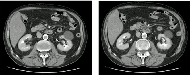 nephroureterectomy.jpg