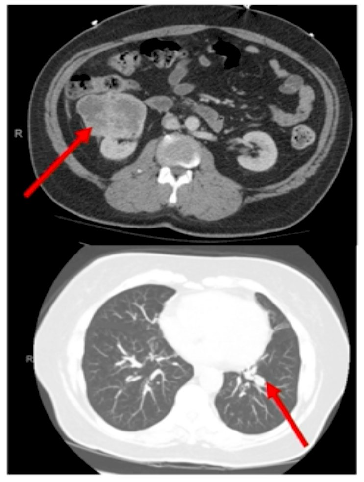 rcc lesion image 2