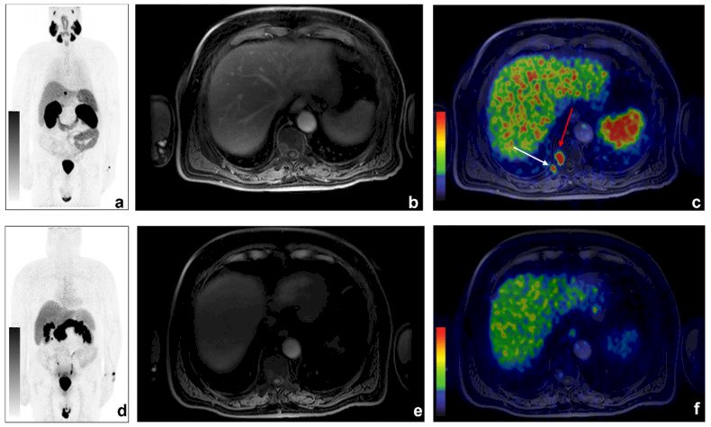 68Ga-PSMA-PET/CT images