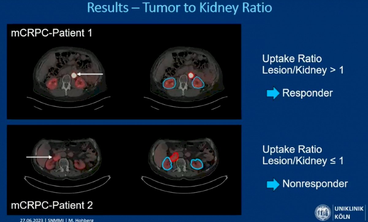 tumor to kidney ratio