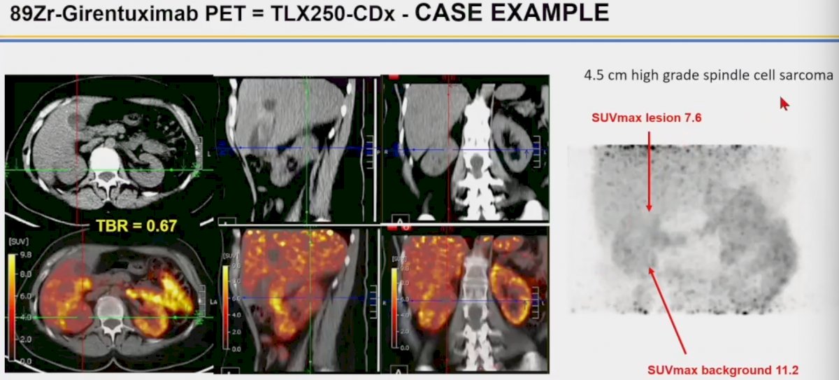 89Zr-girentuximab images