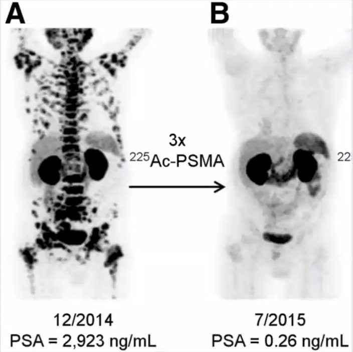 225 ac psma images