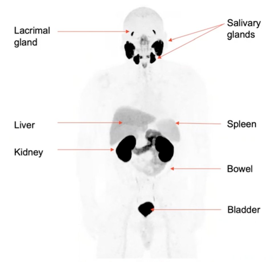 18F-DCFPyL PET/CT -0.jpg