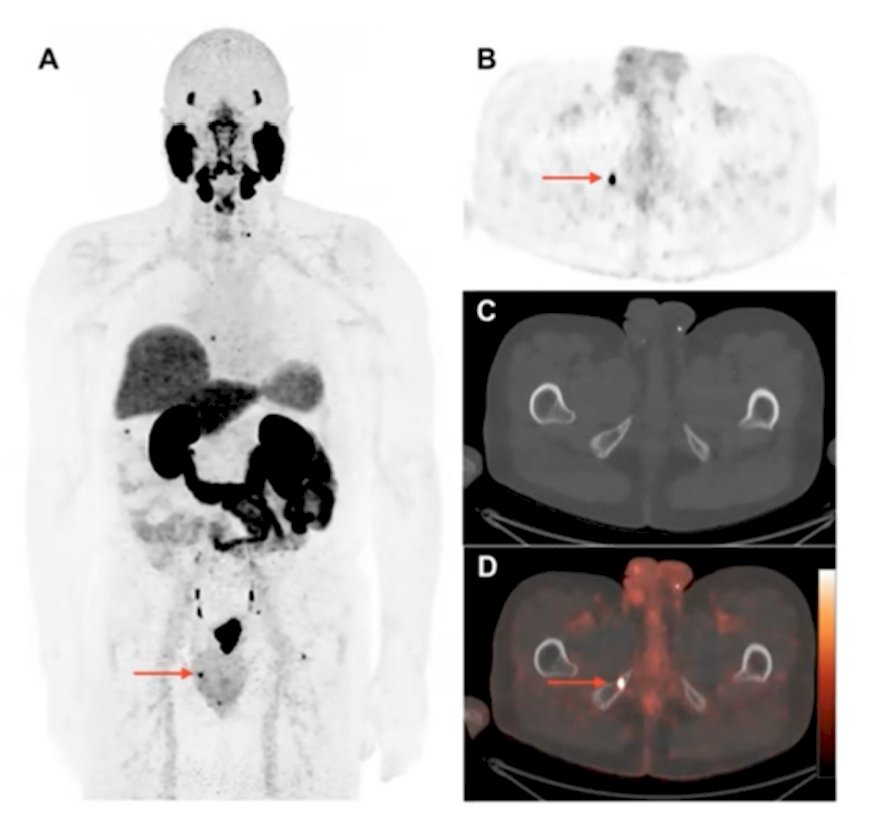 18F-DCFPyL PET/CT-5.jpg