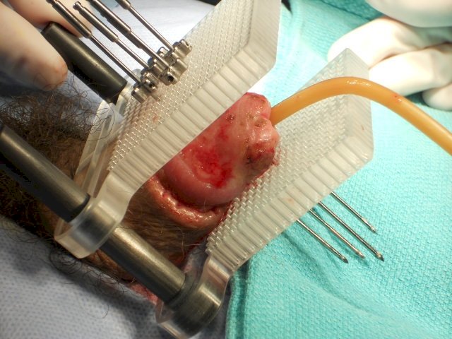 penile cancer Brachytherapy image 2