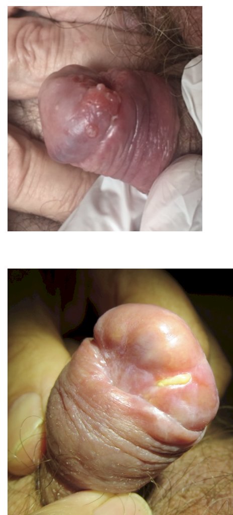 HPV positive for penile squamous cell carcinoma