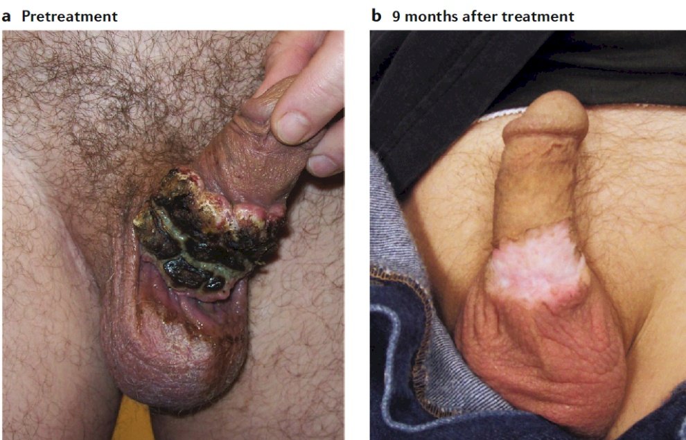 evidence of disease for 7 years with the following pre-treatment and 9 month post treatment images