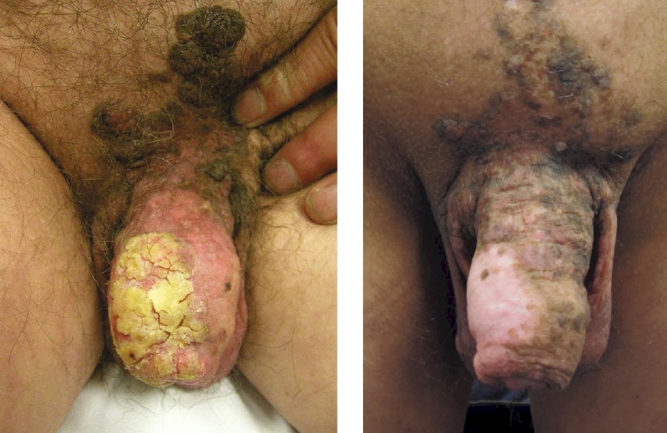 T1bN3 penile squamous cell carcinoma