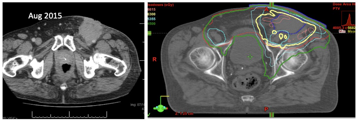pelvic lymph node images