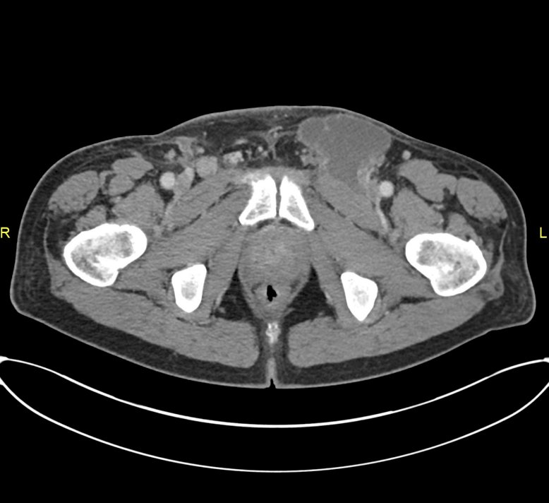 bulky inguinal lymphadenopathy image