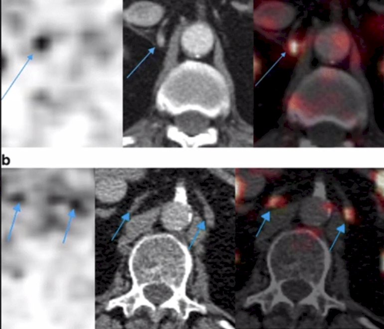 physiologic celiac ganglion uptake image