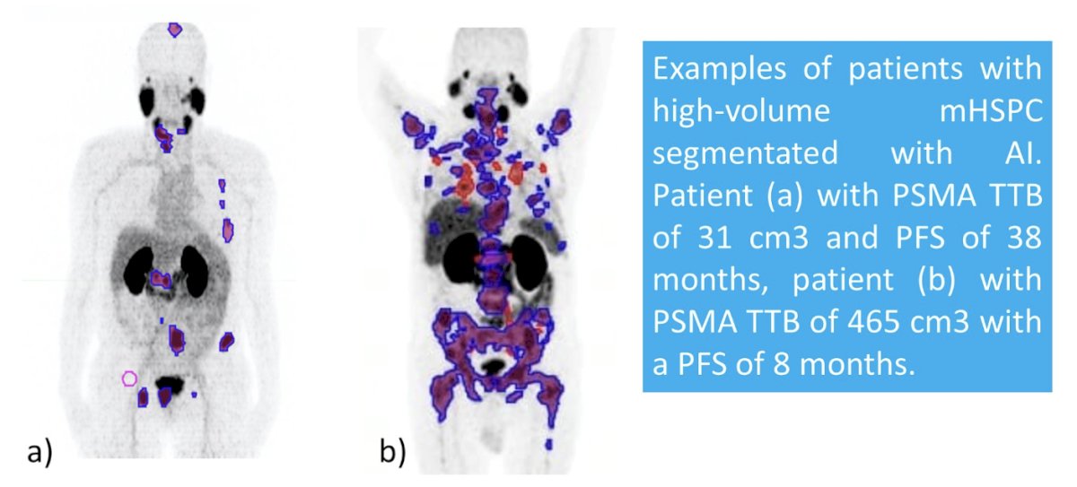 examples of patients with high volume mHSPC segmented with artificial intelligence
