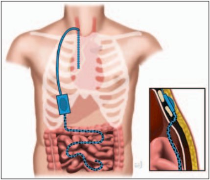 Peritovenous shunting