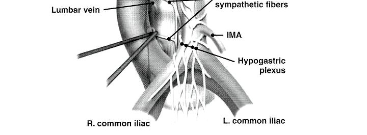 most common complication being retrograde ejaculation secondary to disruption of the post-ganglionic sympathetic fibers