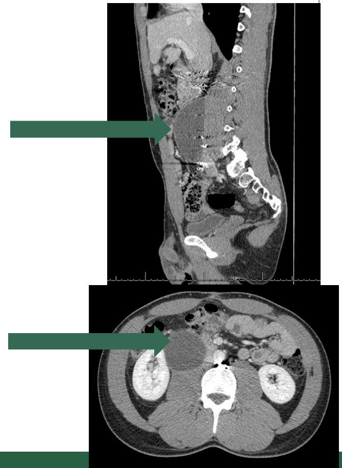 lymphocele