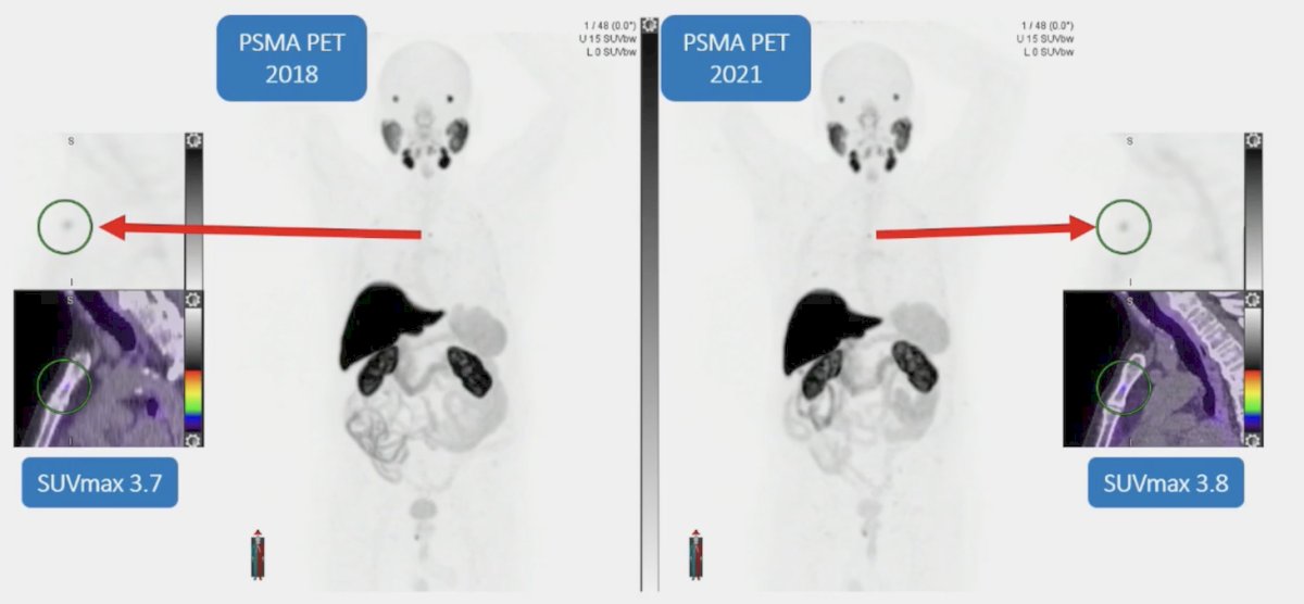 18F-PSMA-1007