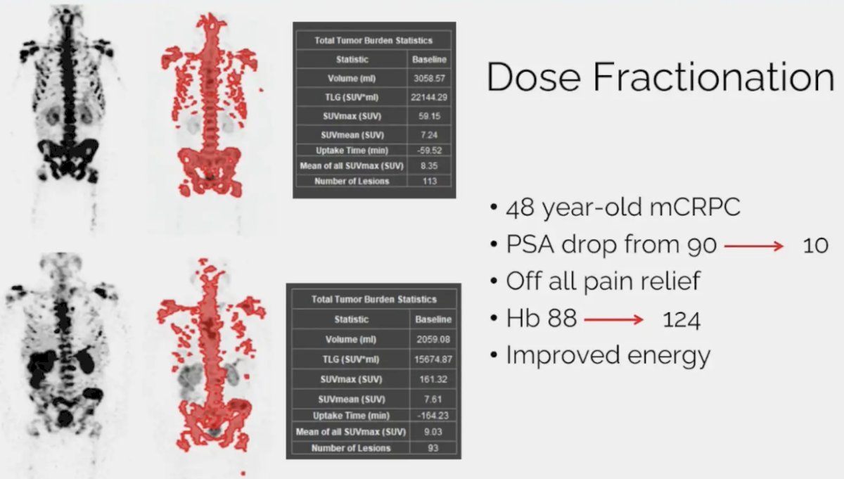 177Lu-PSMA-617 dose fractionation