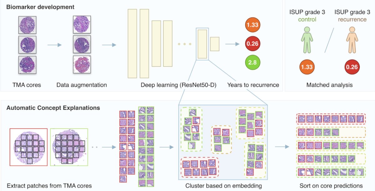 artificial intelligence to predict biochemical recurrence