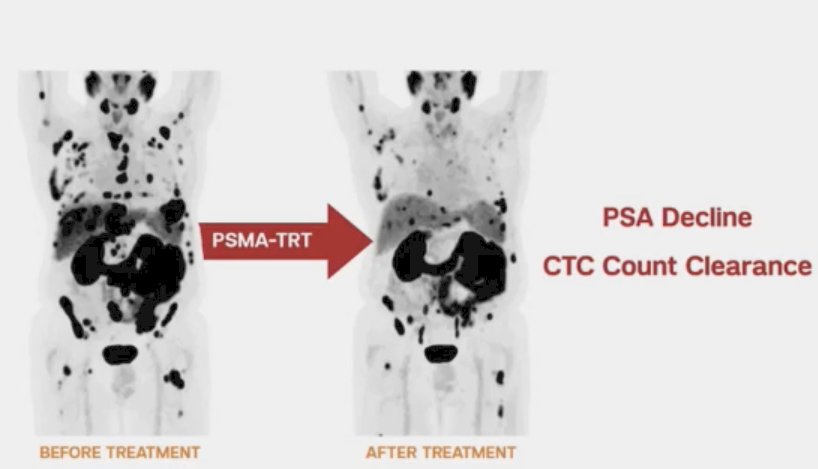 imaging parameter after radioligand therapy