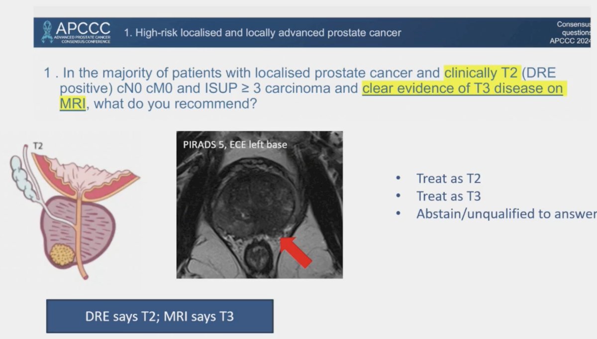 patient has cT2 per DRE, but the MRI suggests the presence of T3 disease
