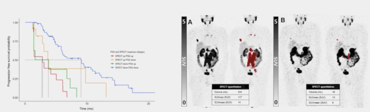 post-treatment SPECT changes in tumor volume correlate with overall survival.