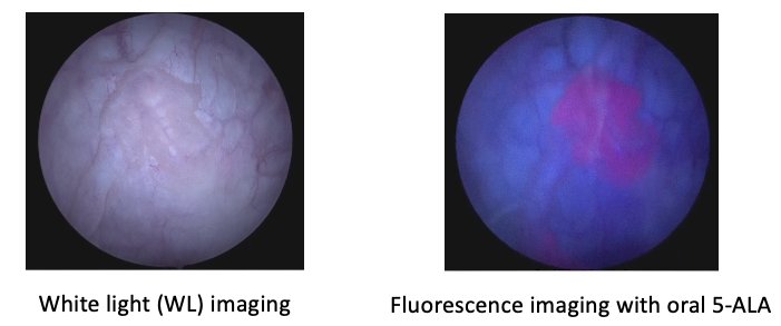 white light imaging compared to fluorescence imaging with oral 5-ALA
