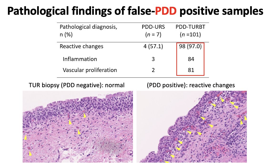 Most of the PDD false-positive samples in the PDD-TURBT cohort had features of reactive changes, such as inflammation and vascular proliferation