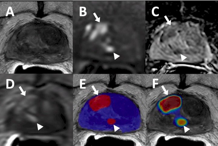 mong 62 patients having prostate lesions assessed after prostate radiotherapy, the artificial intelligence model performance was lower than the prospective radiology interpretation (artificial intelligence: 76.1% vs radiologist: 91.3%, p = 0.02) and lesion level (artificial intelligence: 71.4% vs radiologist: 87.5%, p = 0.01)