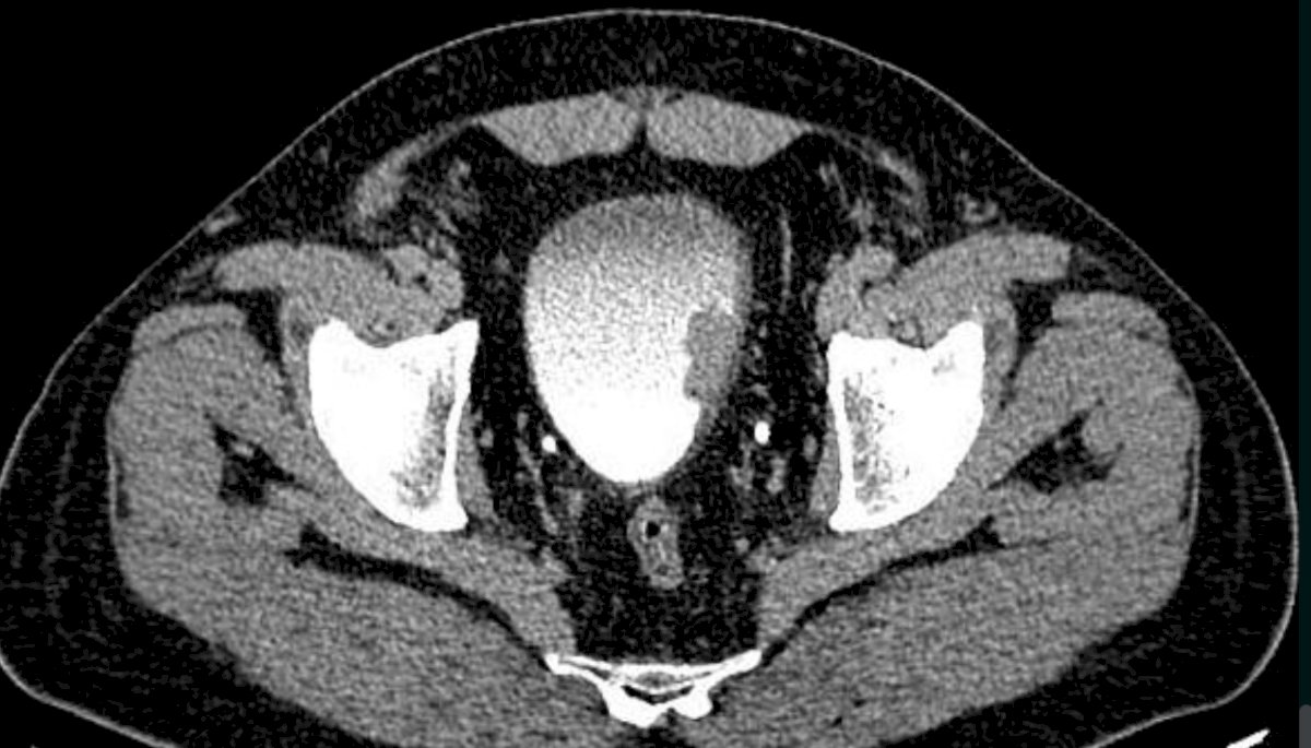 Case #2 was a 65 year old man with a 3 cm unifocal cT2N0 high grade urothelial cancer, with no associated CIS at the left lateral bladder wall that was completely resected on TURBT