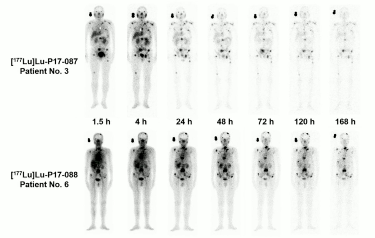 ive metastatic castration-resistant prostate cancer patients received 177Lu-P17-087 and four other patients received 177Lu-P17-088 (1.20 GBq/patient)