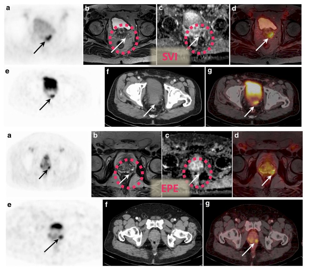 worse agreement in seminal vesicle involvement (k = 0.31) and extraprostatic extension (k = 0.25) assessment