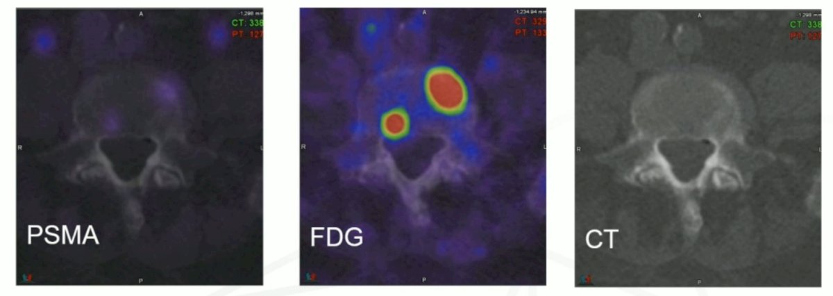 Dr. Hofman notes that for precision medicine, patient selection is key. Specifically, FDG PET/CT makes invisible PSMA-negative bone metastasis visible