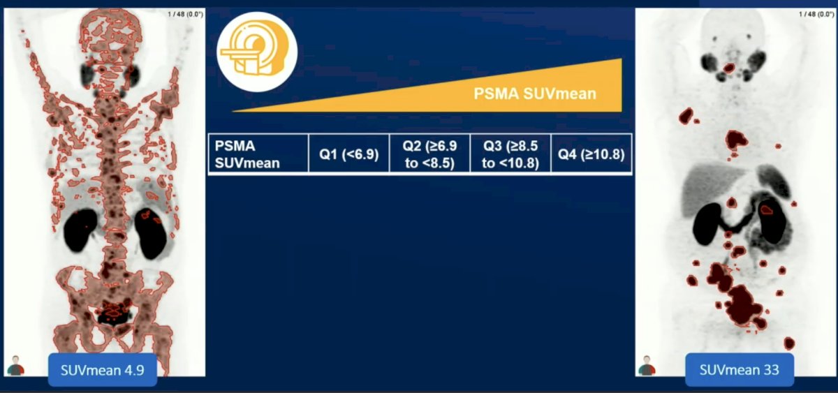 Quantitative PET is powerful, since the total tumor measure is superior to individual lesions, requiring automated reproducible solutions. PSMA SUVmean is a reasonable biomarker, as is 18F-FDG [4] (superior to ECOG, ALP, hemoglobin, bone metastases, and liver metastases