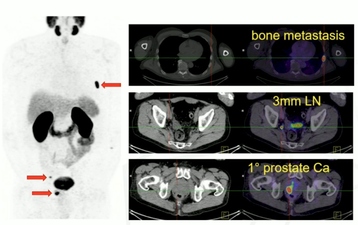 The first PSMA PET/CT scan was done at Peter Mac in 2014 on a patient with Gleason 9 prostate cancer with normal conventional imaging. His PSMA PET/CT showed bone metastasis, a 3 mm lymph node and primary prostate cancer