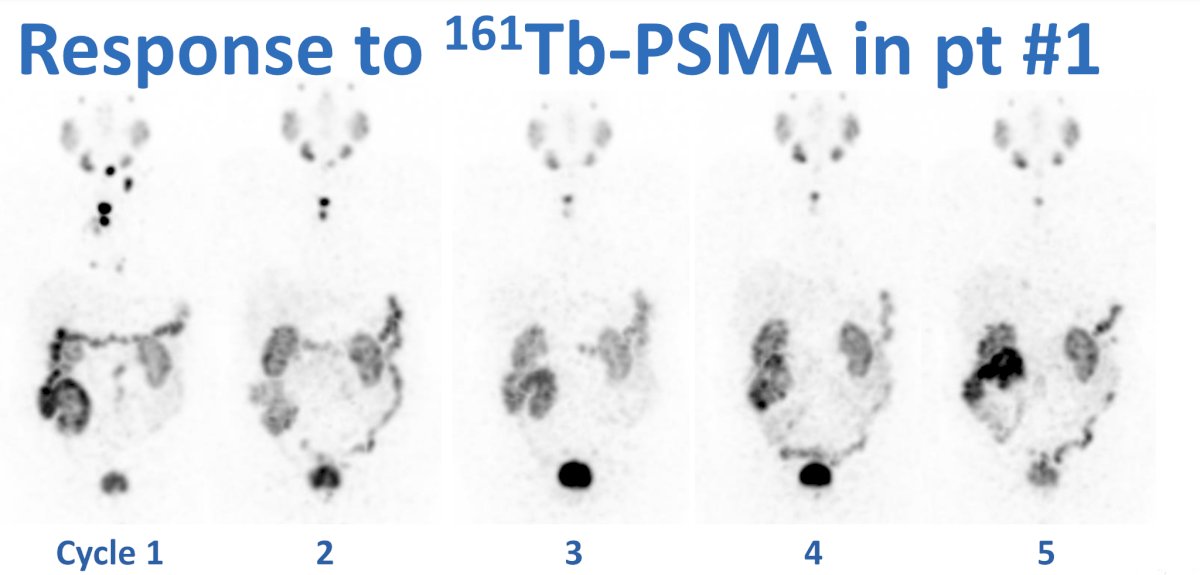response to 161Tb-PSMA-I&T in patient #1 (PSA decline to 5 cycles of treatment: 16 &nbsp; 0.7 ng/mL)