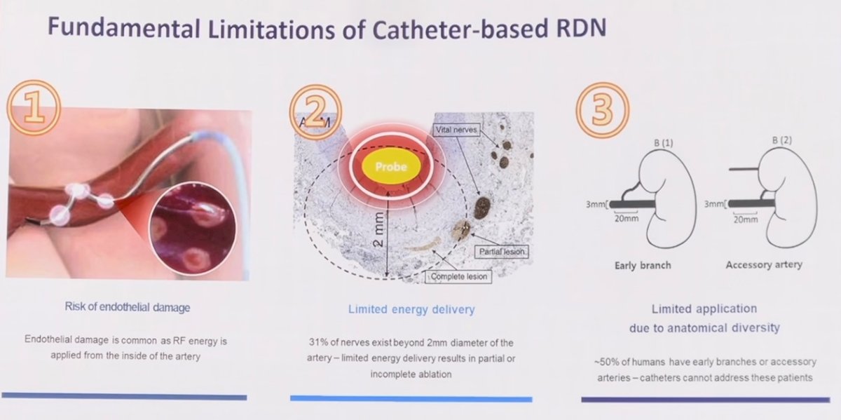 three fundamental limitations of catheter-based RDN