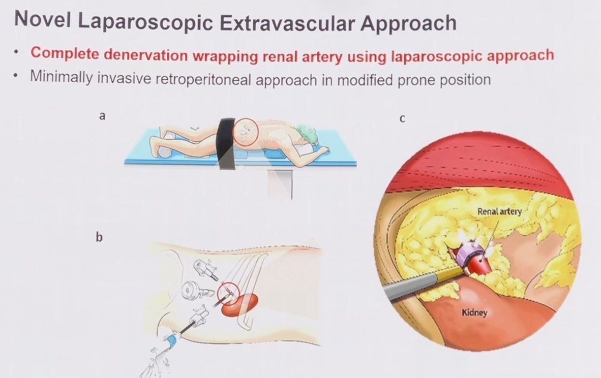 novel laparoscopic extravascular RDN approach