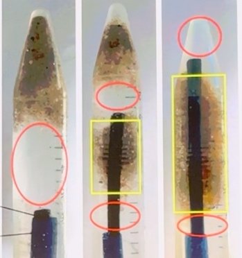 Optimal placement of flexible ureteral access sheath in retrograde intrarenal surgery