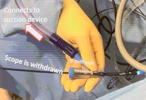 Flexible and Navigable Suction UAS (FANS) intraoperative configuration.