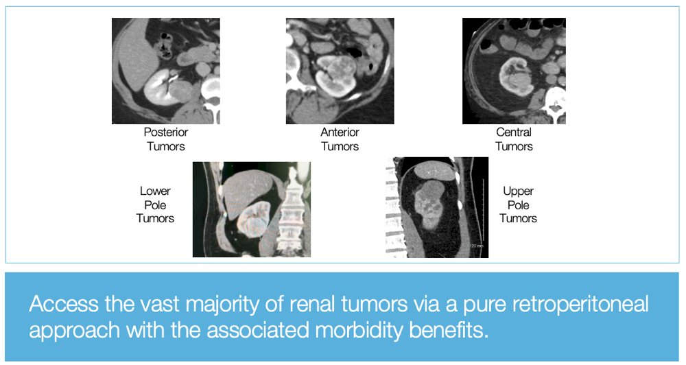 Supine Anterior Retroperitoneal Access via robotic single-port surgery