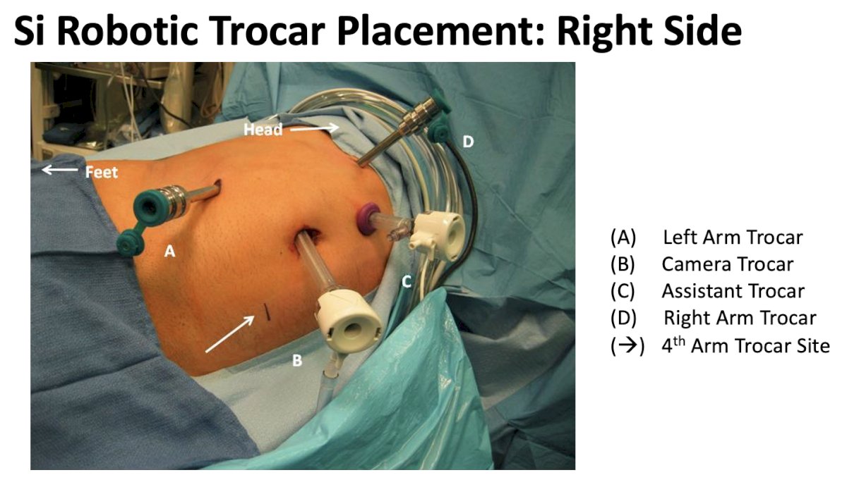 robotic surgery minimizes the length and number of incisions required for specimen extraction compared to laparoscopic surgery.