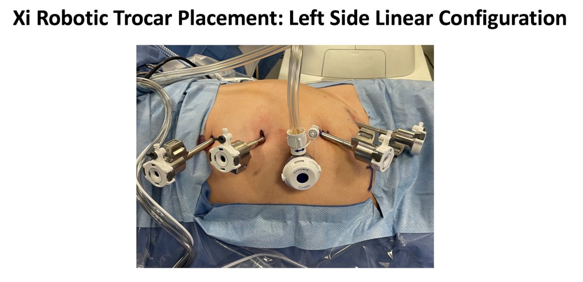 xi robotic trocar placement