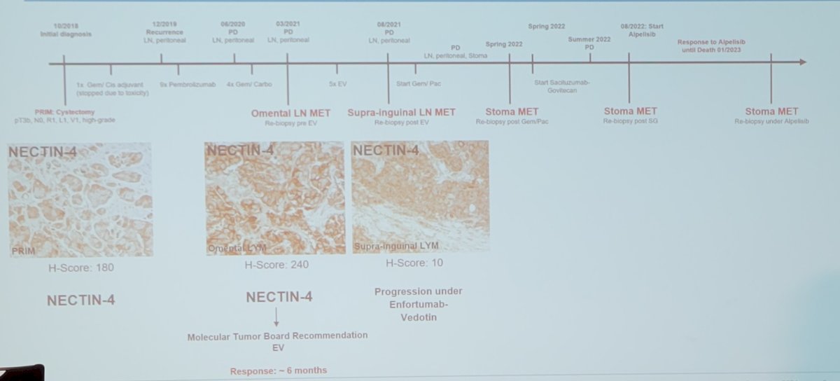 timeline highlights an anecdotal case from Dr. Eckstein’s molecular tumor board in the pre enfortumab vedotin era