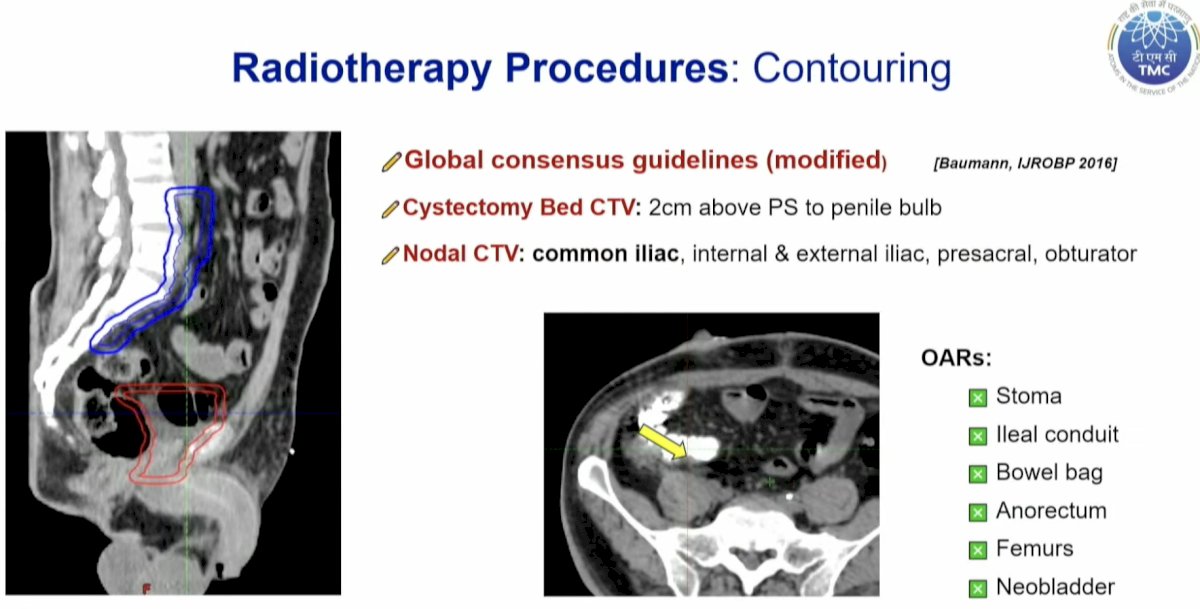 The contouring volume was modified to include the cystectomy bed (2 cm above the pubic symphysis to the penile bulb). They also included the common iliac nodes up to the aortic bifurcation in the radiotherapy clinical target volume