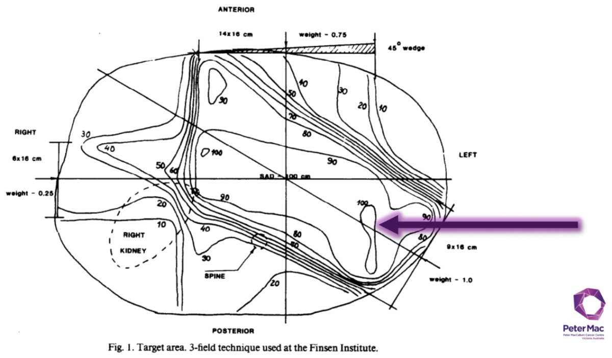radiotherapy for RCC in the 1980s was associated with high rates of complications